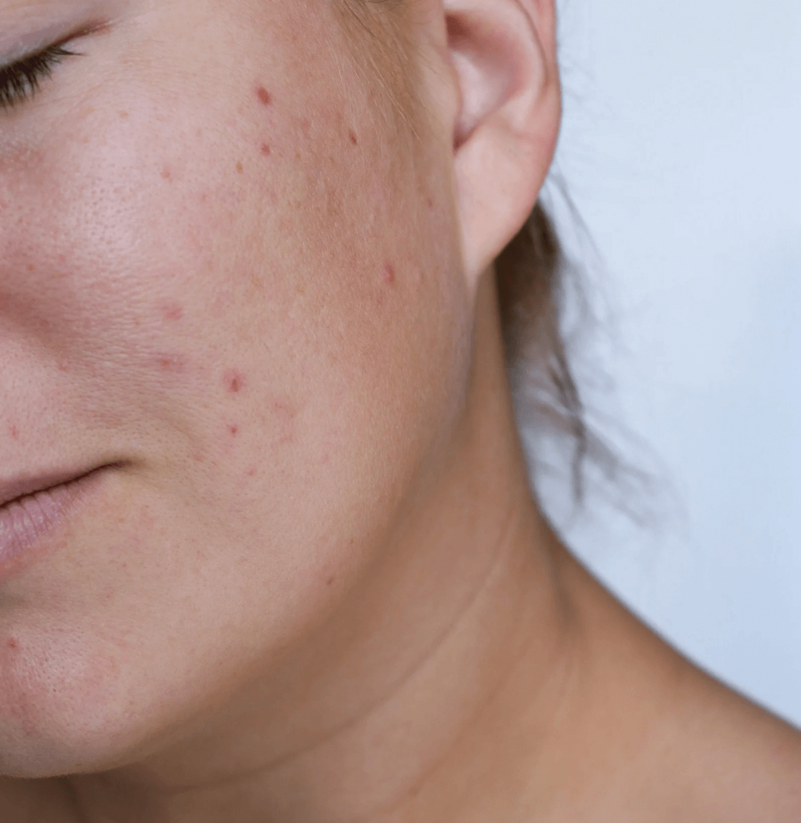 Narbenpflege-narben-behandeln