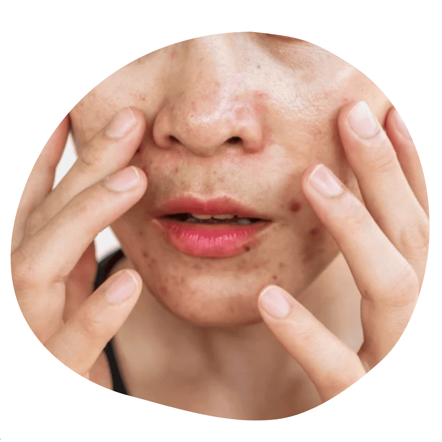 Puræsthetic Skincare-Fettige Haut-Ölige Haut