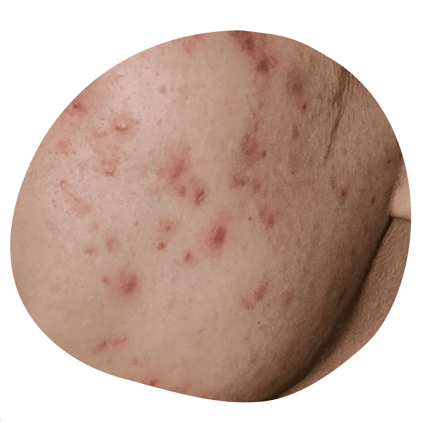 Puræsthetic Skincare-Impure skin